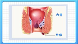 第73集 痔瘡
